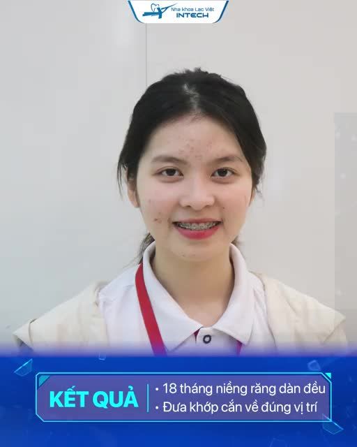 TOP 3 ca niềng răng thành công nhờ mắc cài kim loại tự động