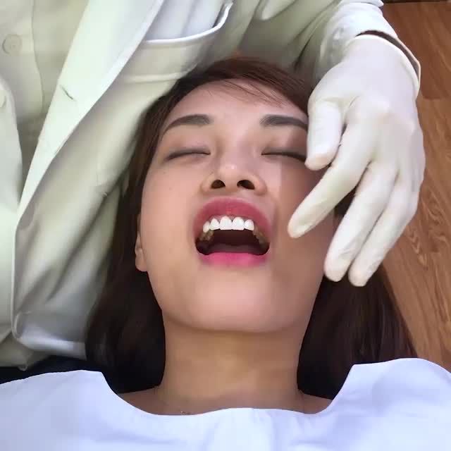 ƯỚM THỬ VENEER SỨ TRƯỚC KHI LẮP CỐ ĐỊNH LÊN RĂNG CHO NỮ KHÁCH HÀNG
