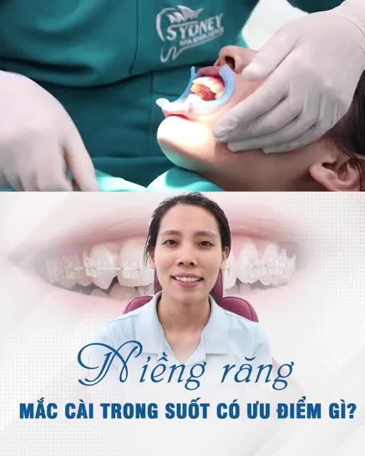 ƯU ĐIỂM CỦA NIỀNG RĂNG MẮC CÀI TRONG SUỐT