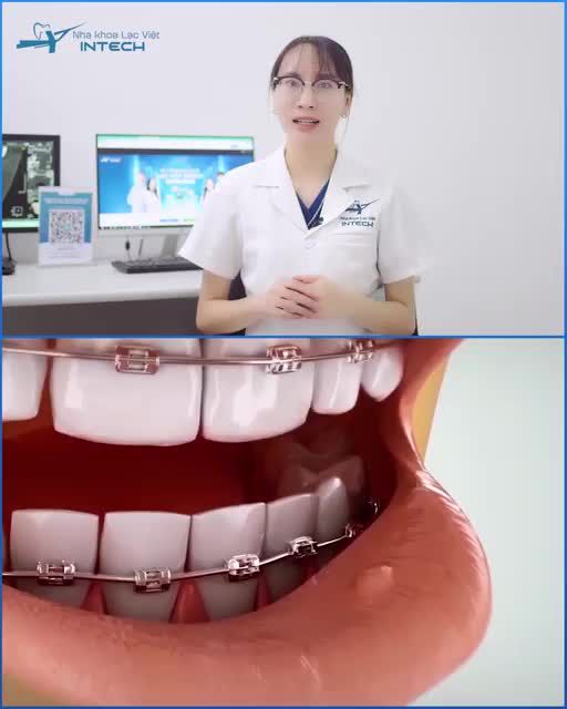 VÌ SAO NIỀNG RĂNG HAY BỊ NHIỆT MIỆNG