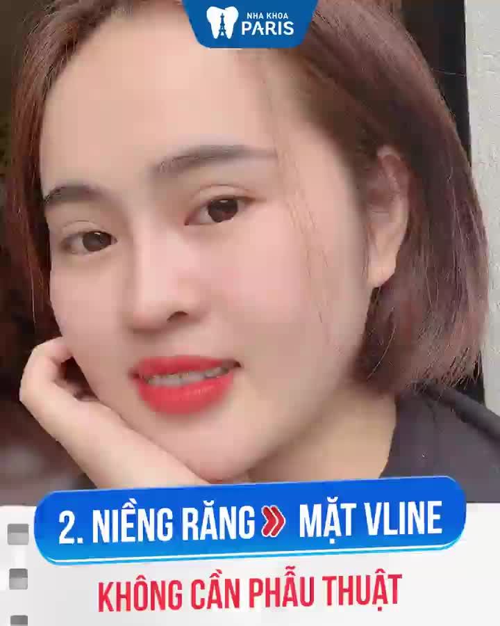 Vì Sao Niềng Răng Ngày Càng HOT