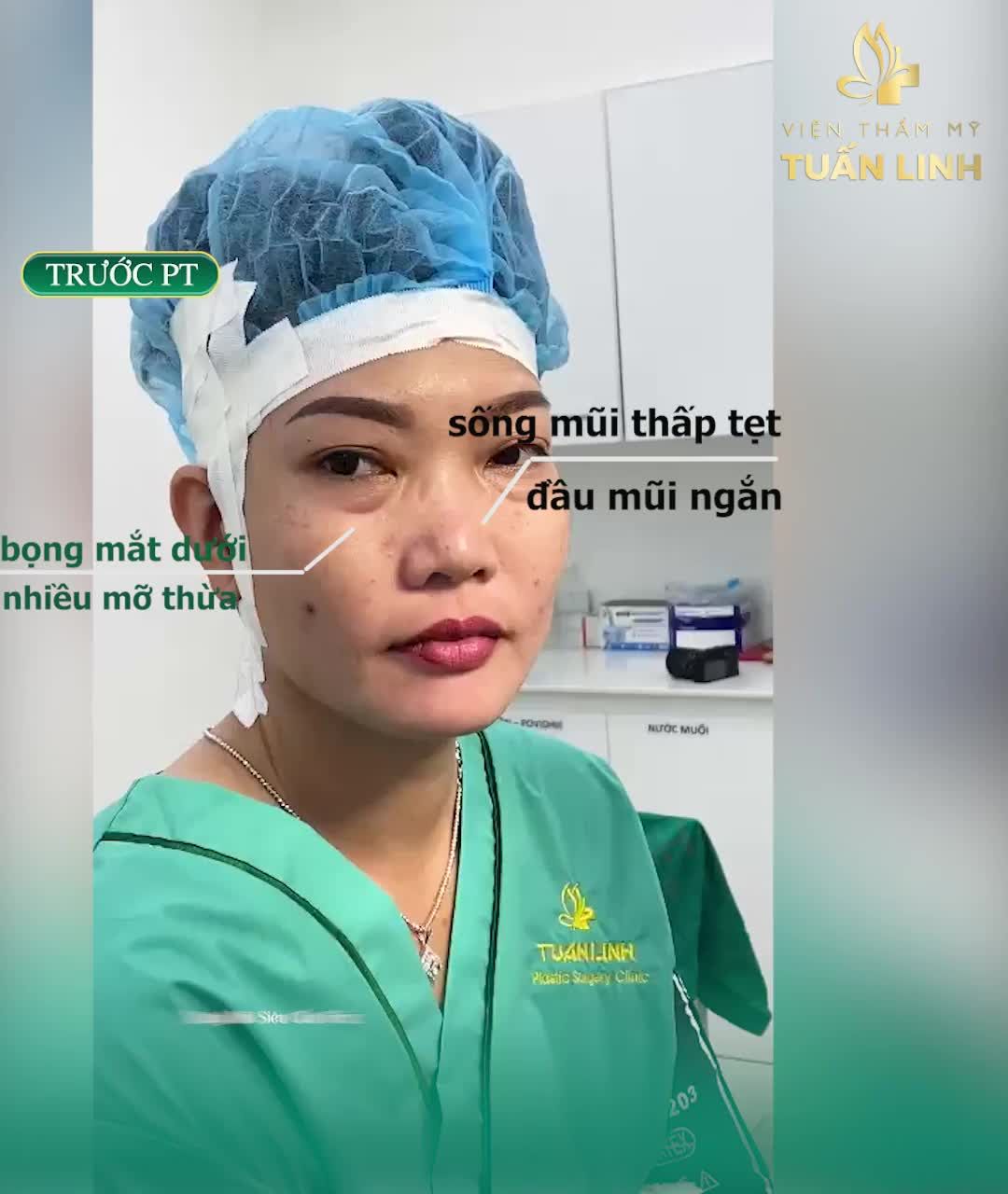Nâng mũi siêu cấu trúc Surgifom + cắt mí dưới