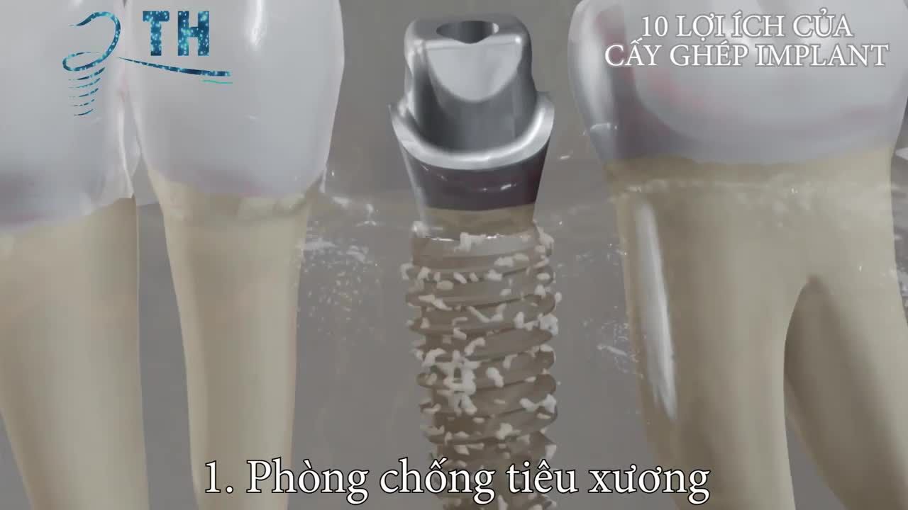 10 LỢI ÍCH CỦA CẤY GHÉP IMPLANT CÓ THỂ BẠN CHƯA BIẾT
