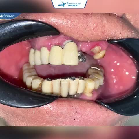 10 NĂM MẤT RĂNG VÀ HÀNH TRÌNH TRỒNG IMPLANT TOÀN 2 HÀM