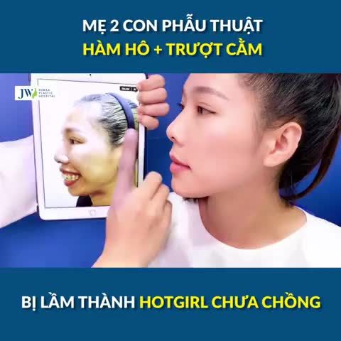 Phẫu thuật hàm hô Trượt cằm MẸ 2 CON đỏ mặt bị lầm thành HOTGIRL CHƯA CHỒNG vì quá TRẺ ĐẸP