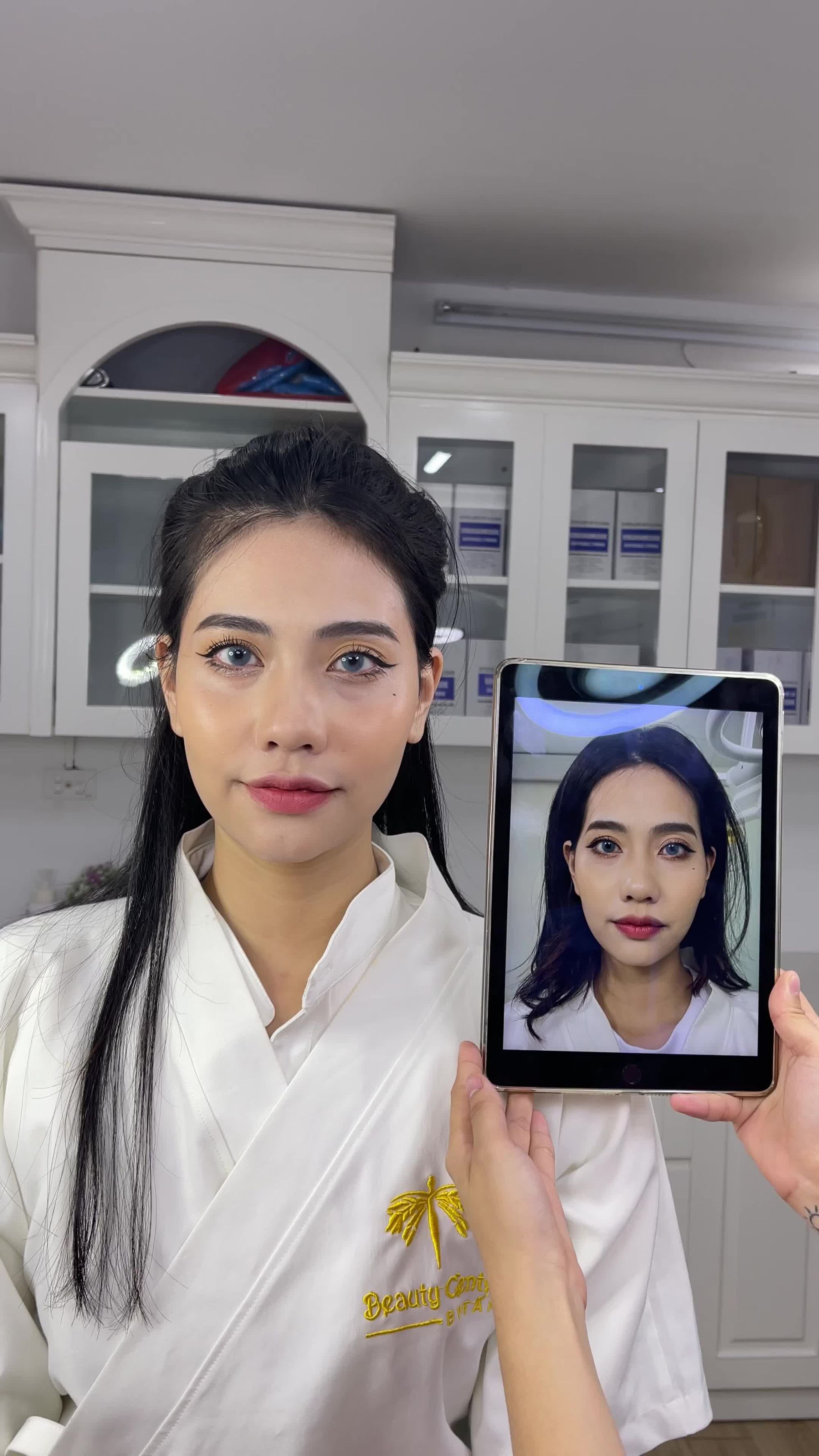 Sự thay đổi rõ rệt trước và sau khi thực hiện ca làm đầy thái dương cho tiktoker Châm Sứa. Khuyết điểm được cải thiện 80% - 90%