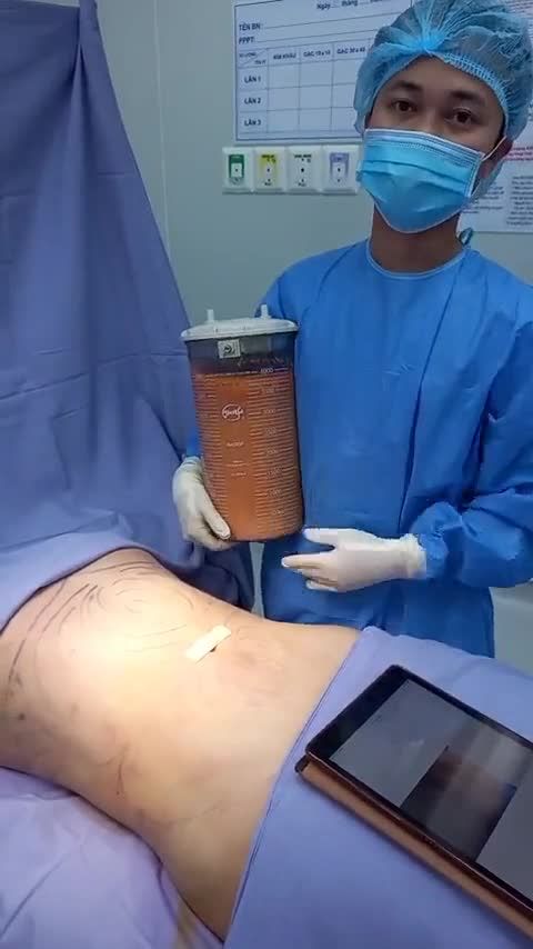 Đại lễ 29 - Tranh thủ về dáng thần tốc với công nghệ Hút mỡ Vaser 4D