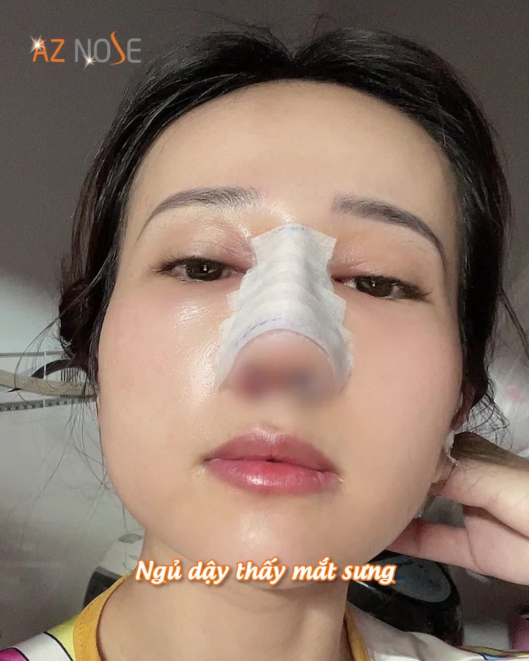 Hành trình tạm biệt mũi tẹt của nàng 9X