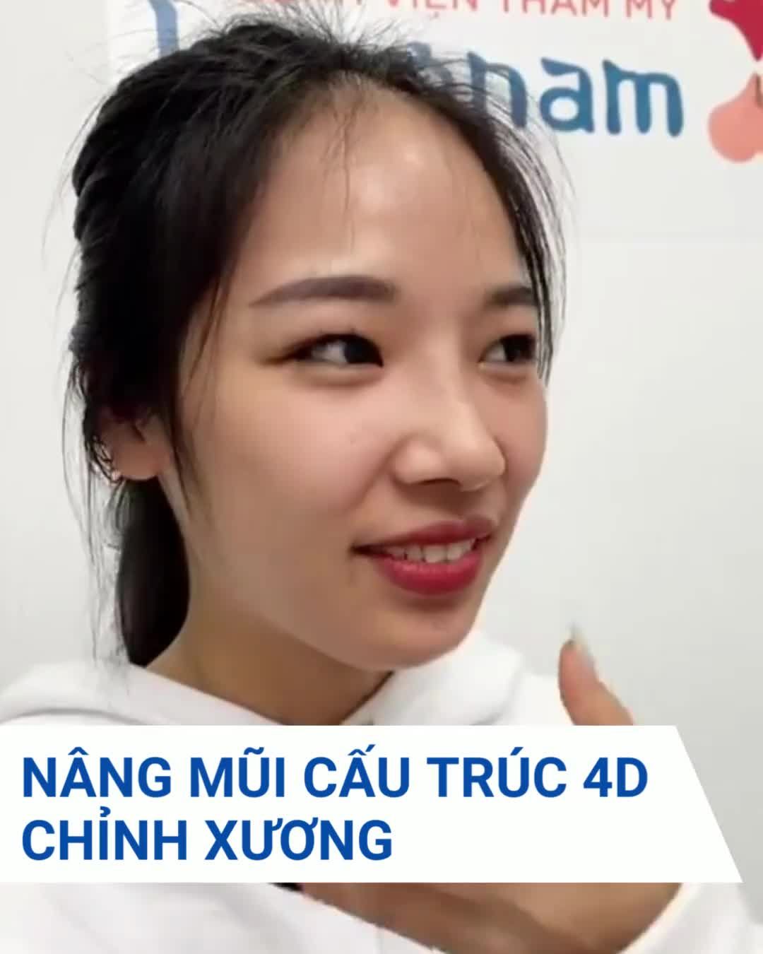 Mê luôn dáng mũi sau 1 tháng nâng mũi cấu trúc 4D + chỉnh xương