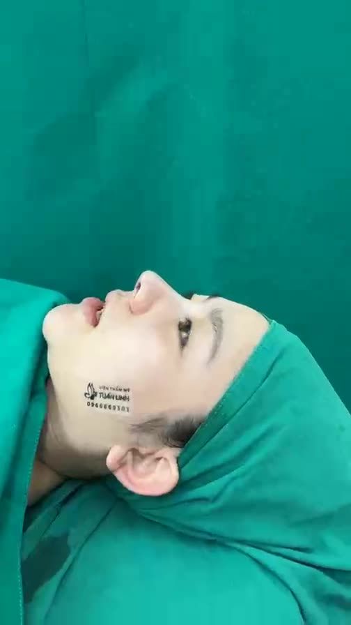 Nâng mũi cấu trúc cho cô bé thích dáng cao tây