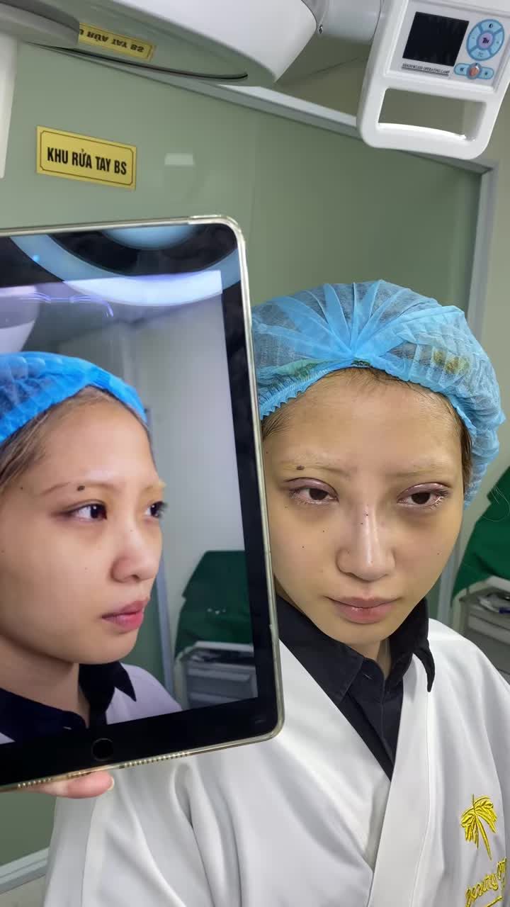 Tiktoker Zika thực hiện cùng lúc combo cắt mí - nâng mũi tại Tấm