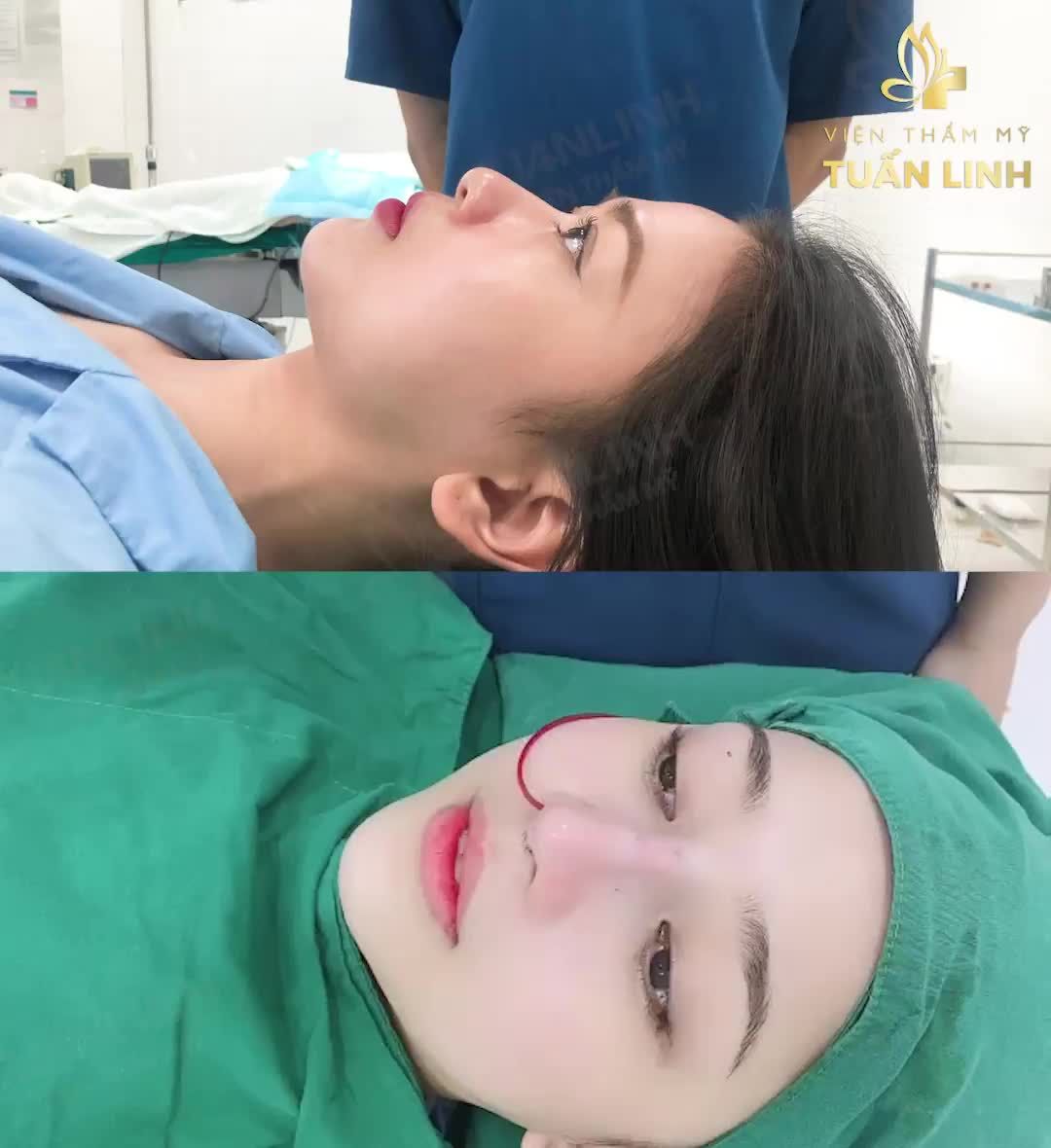 Khách hàng nhà Tuấn Linh ''lột xác'' đầy xinh đẹp và sắc nét sau nâng mũi cấu trúc sụn Surgiofrm.