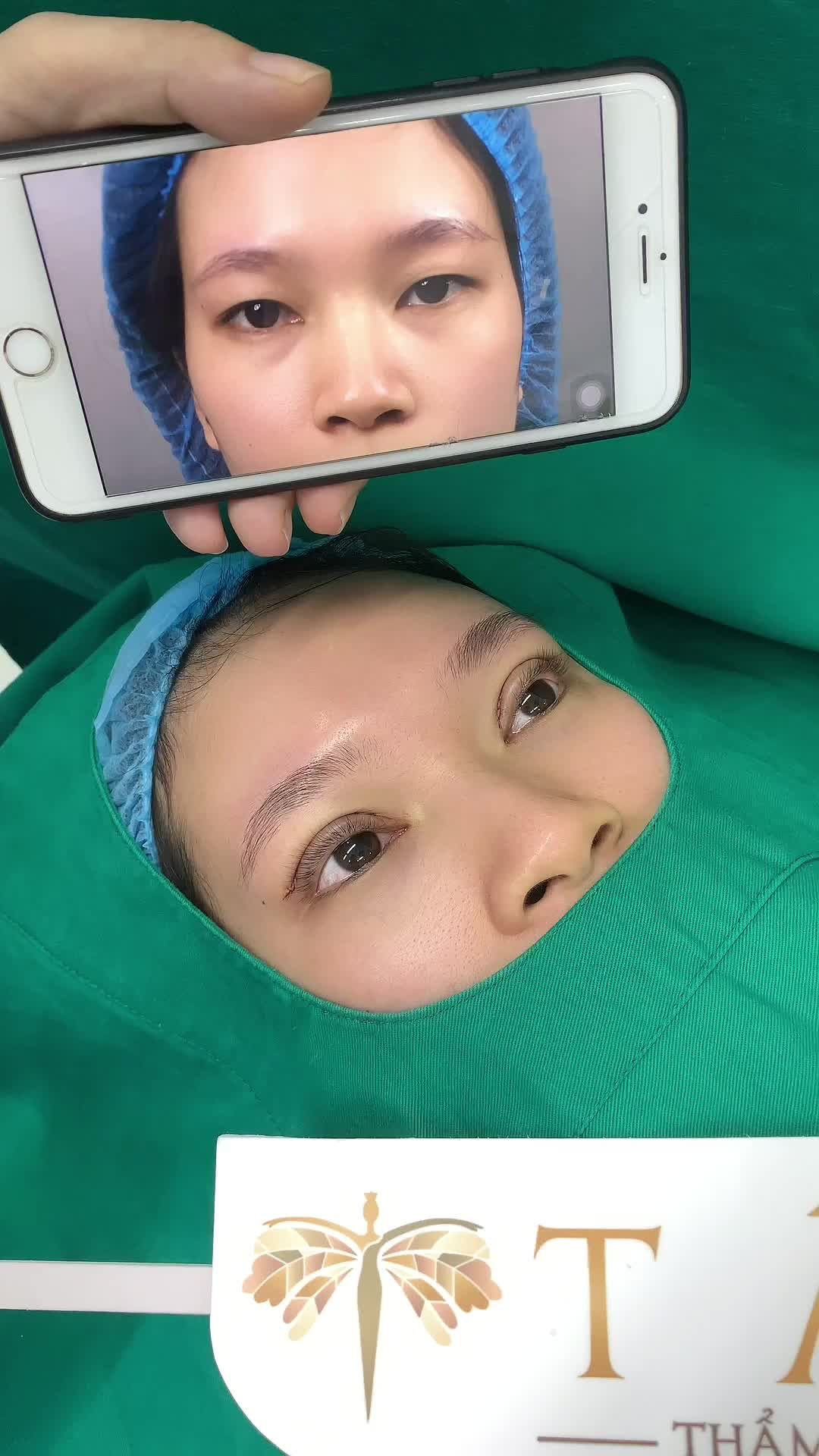 Chiêm ngưỡng thành quả sau 45 phút, biến đôi mắt mí sụp, nhiều mỡ mắt thành đôi mắt 2 mí tại TMV Tấm