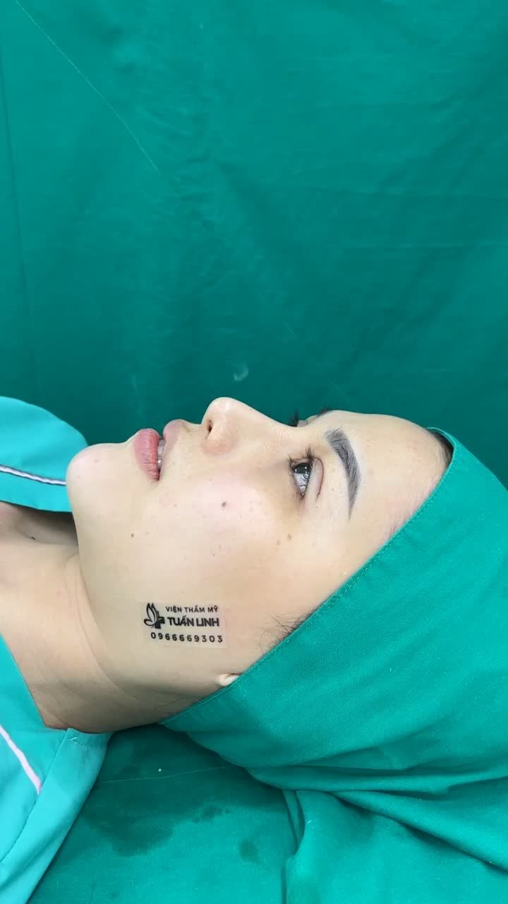 COMBO ĐỘN CẰM + CẮT MÍ PLASMA