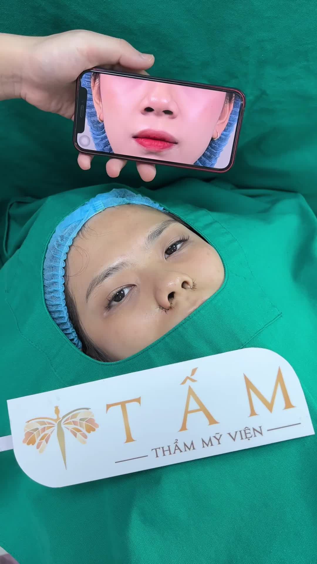 Kết quả ca thu nền mũi + cánh mũi với thay đổi cực rõ rệt