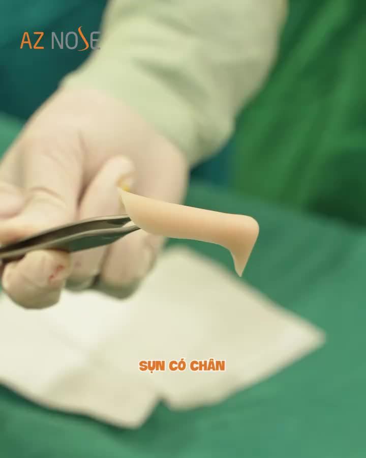 Sụn không chân và sụn có chân có gì khác biệt