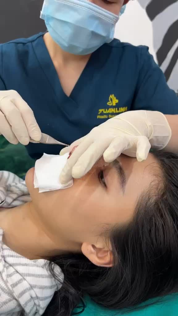 THÁO GẠC MŨI SAU 2 NGÀY PHẪU THUẬT
