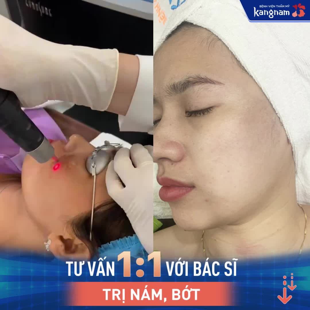 Khó mà tin được Hiệu quả trị nám, bớt bằng Laser Picosure