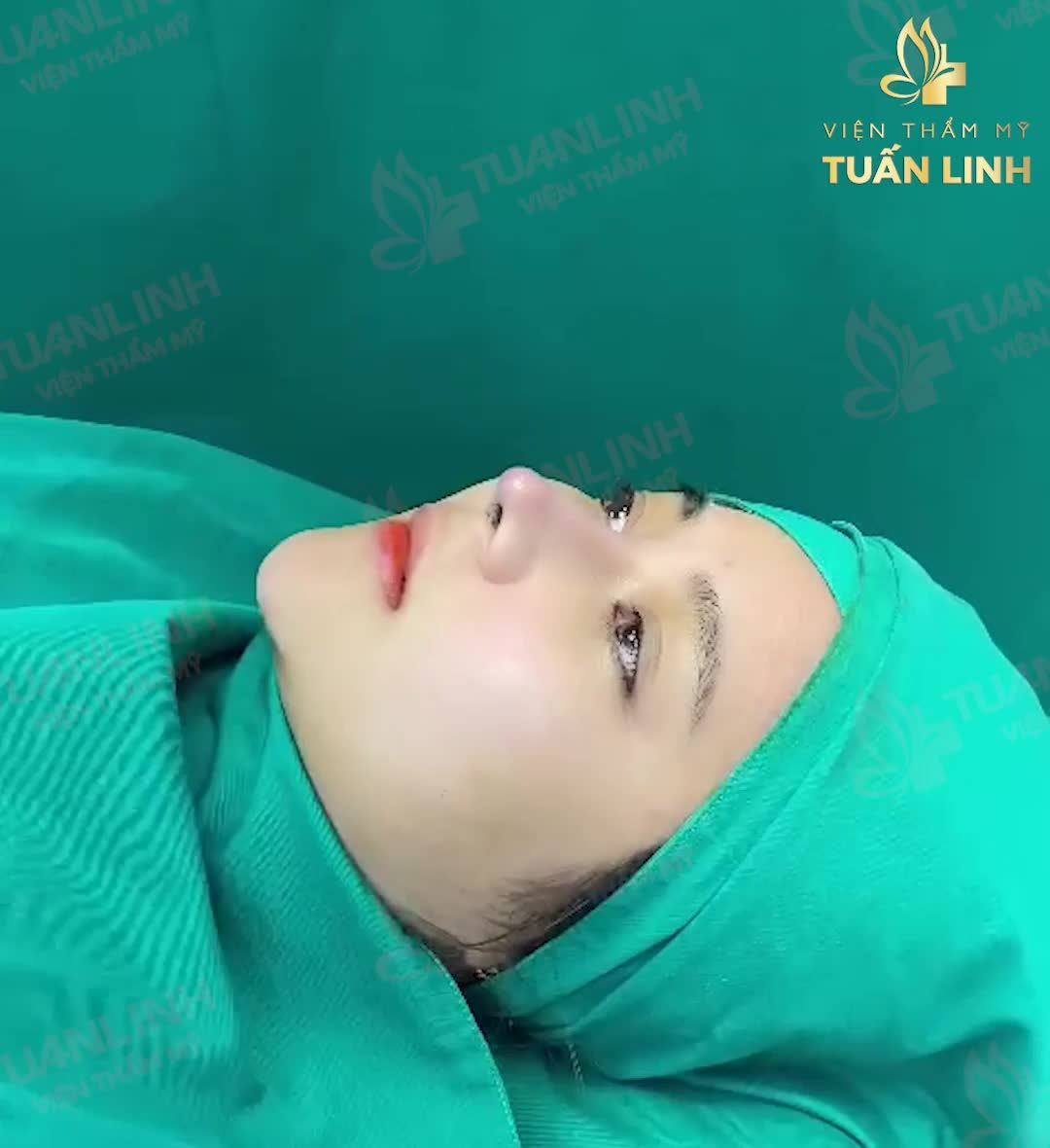 Nâng mũi cấu trúc Surgiform - Đỉnh cao trong tạo hình mũi cao tây, đẹp ấn tượng mà vẫn giữ được nét tự nhiên.