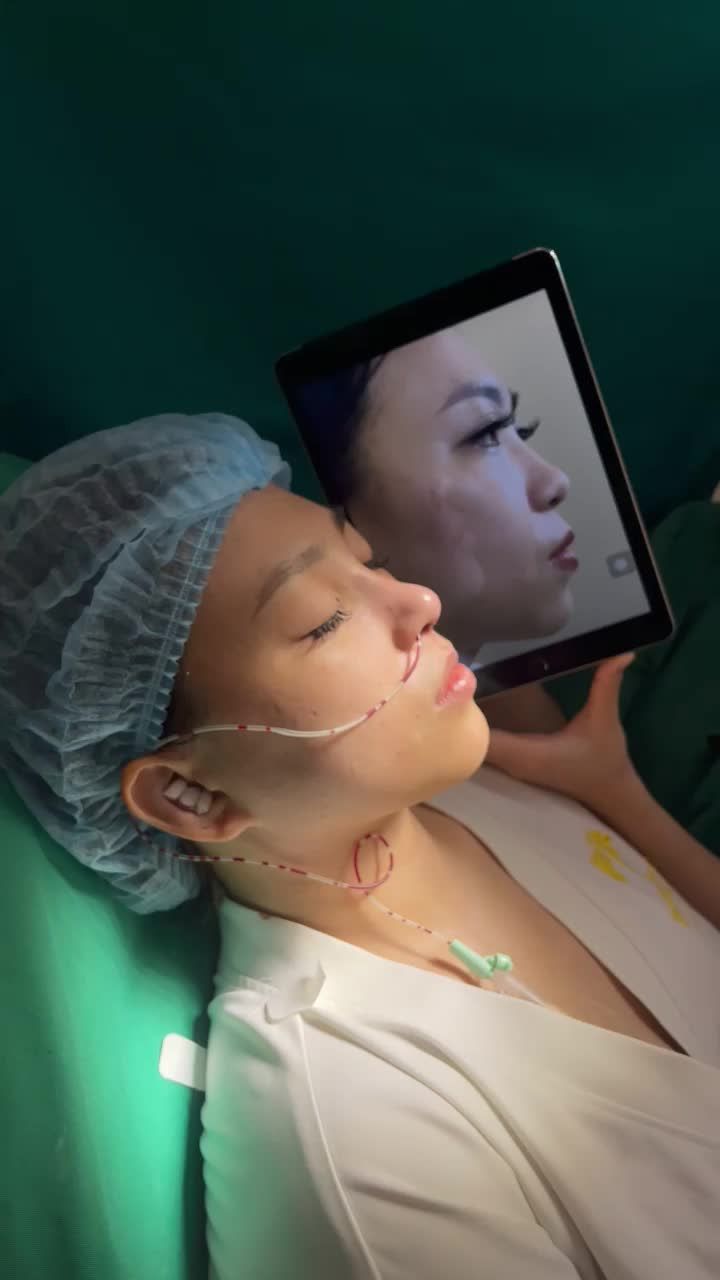 Thay đổi ngay sau làm với dịch vụ nâng mũi Thẩm mỹ viện Tấm