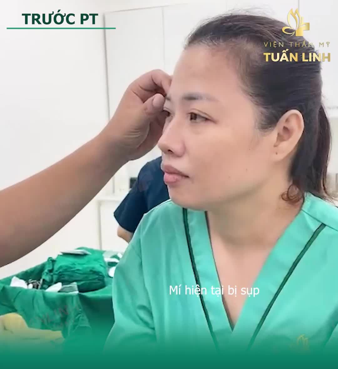 TOÀN CẢNH 150 PHÚT CA NÂNG MŨI SỬA LẠI + CẮT MÍ + ĐỘN CẰM TẠI TUẤN LINH