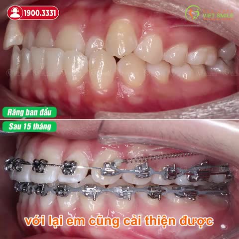 15 THÁNG NIỀNG RĂNG MÓM KHỚP CẮN TỐT HƠN, CƯỜI TỰ TIN HƠN
