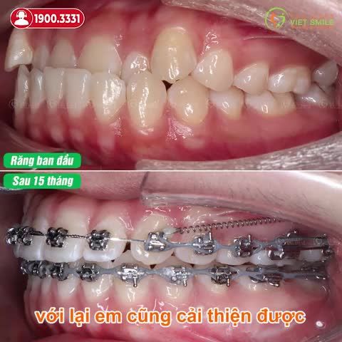15 THÁNG NIỀNG RĂNG MÓM KHỚP CẮN TỐT HƠN, CƯỜI TỰ TIN HƠN
