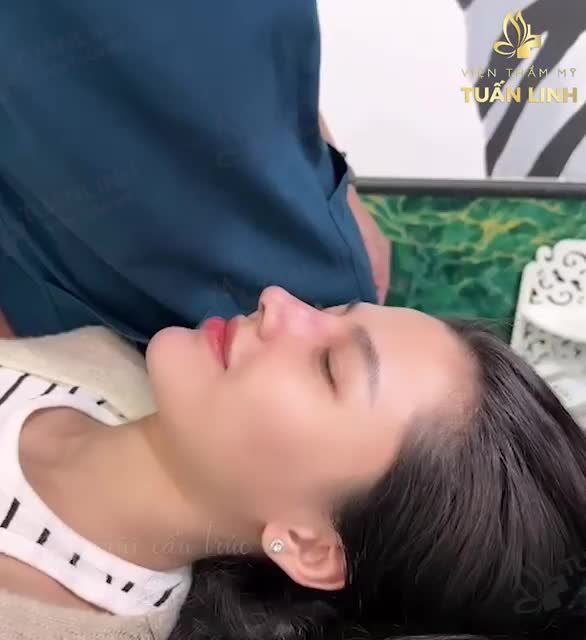 Nâng mũi cấu trúc Surgiform sau 10 ngày tháo nẹp...