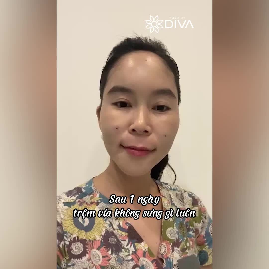 SỞ HỮU GƯƠNG MẶT BABY, NGỌT NGÀO SAU 1 THÁNG THẨM MỸ