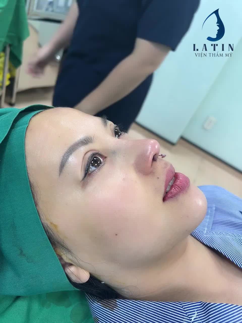 Combo nâng mũi cấu trúc sửa lại + độn cằm nội soi tại Latin