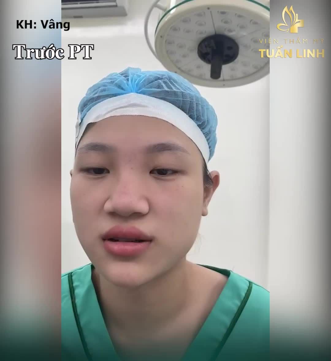 ĐÃ TỪNG NÂNG MŨI CHỈ + TIÊM FILLER NHƯNG QUÁ THẤT VỌNG NÊN BẠN ĐÃ CHỌN PHẪU THUẬT SỬA LẠI MŨI TẠI TUẤN LINH.