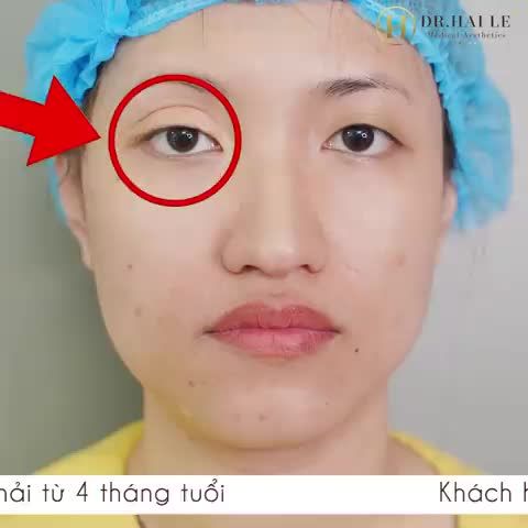Dành cả thanh xuân để tìm một Bác sĩ giỏi sửa lại mí mắt!