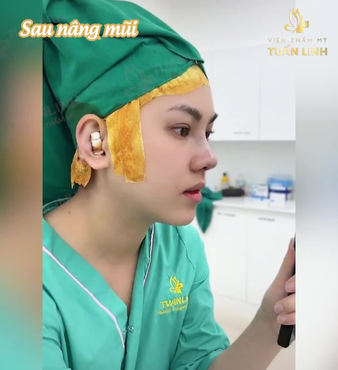 NÂNG MŨI ĐÃ THAY ĐỔI KHUÔN MẶT BẠN NHƯ THẾ NÀO
