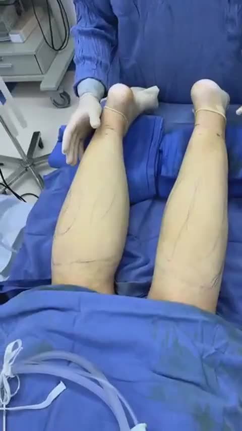 Ngỡ ngàng trước đôi chân trước và sau hút mỡ Vaser 4D