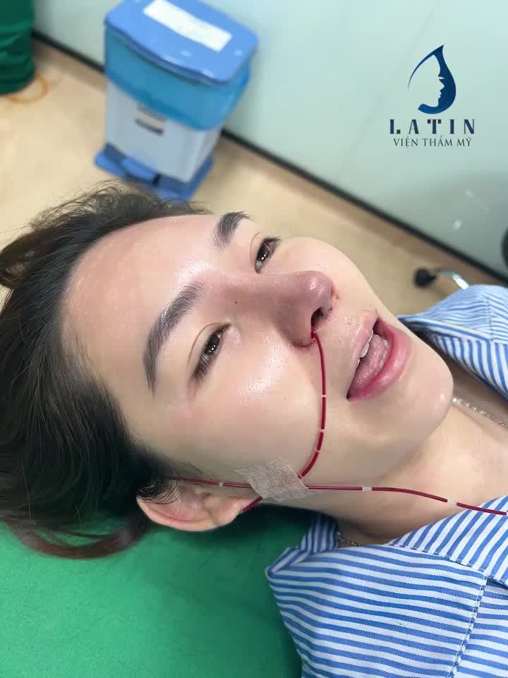 Ca mũi sửa lại cho cô gái lỡ DUYÊN lần 1 với LATIN