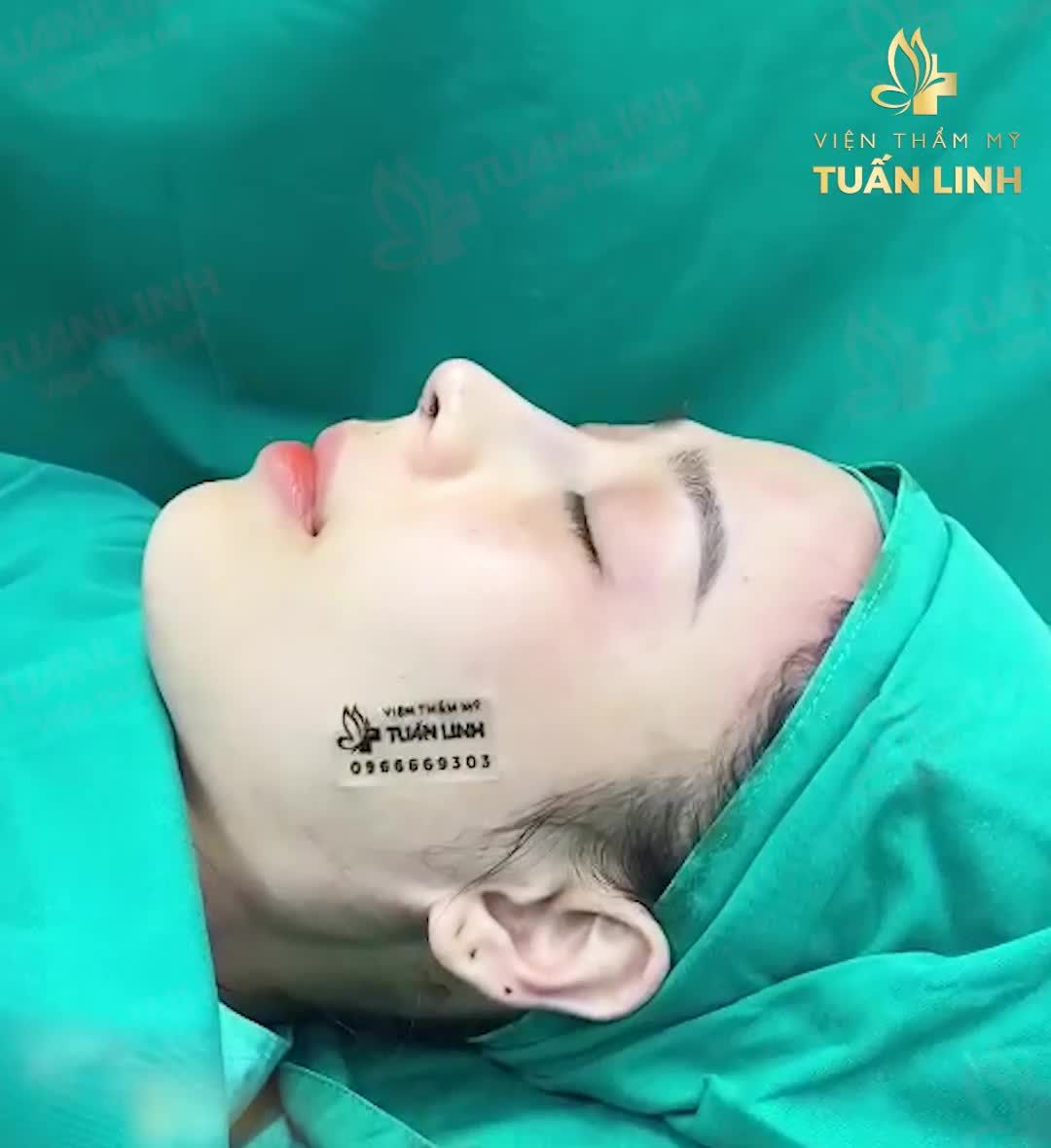 Dáng mũi siêu đẹp, siêu tự nhiên của khách hàng nhà Tuấn Linh ngay sau phẫu thuật