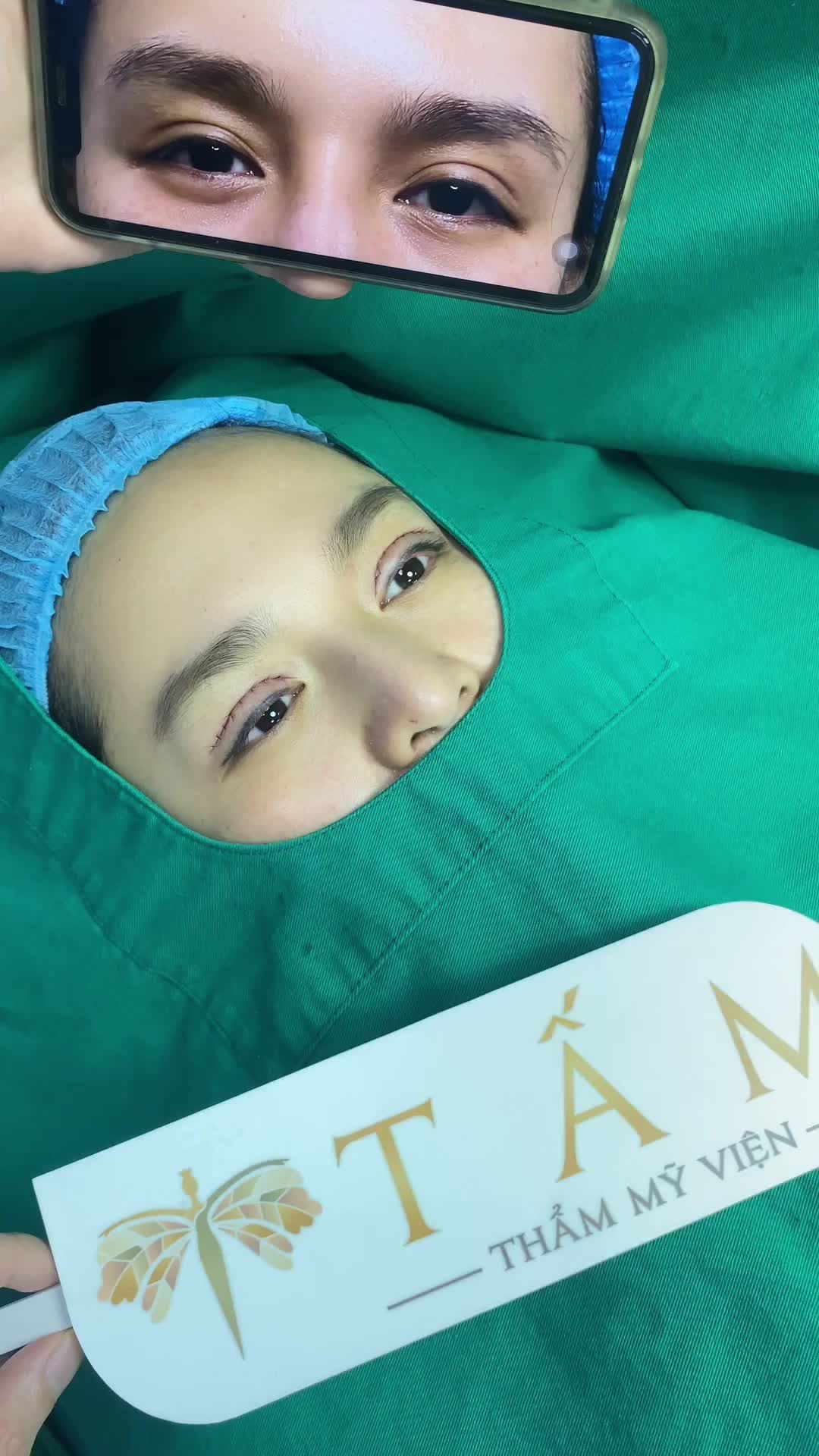 Mời cả nhà cùng theo dõi sự thay đổi rõ rệt trước và sau cắt mí Line Mini tại Tấm.