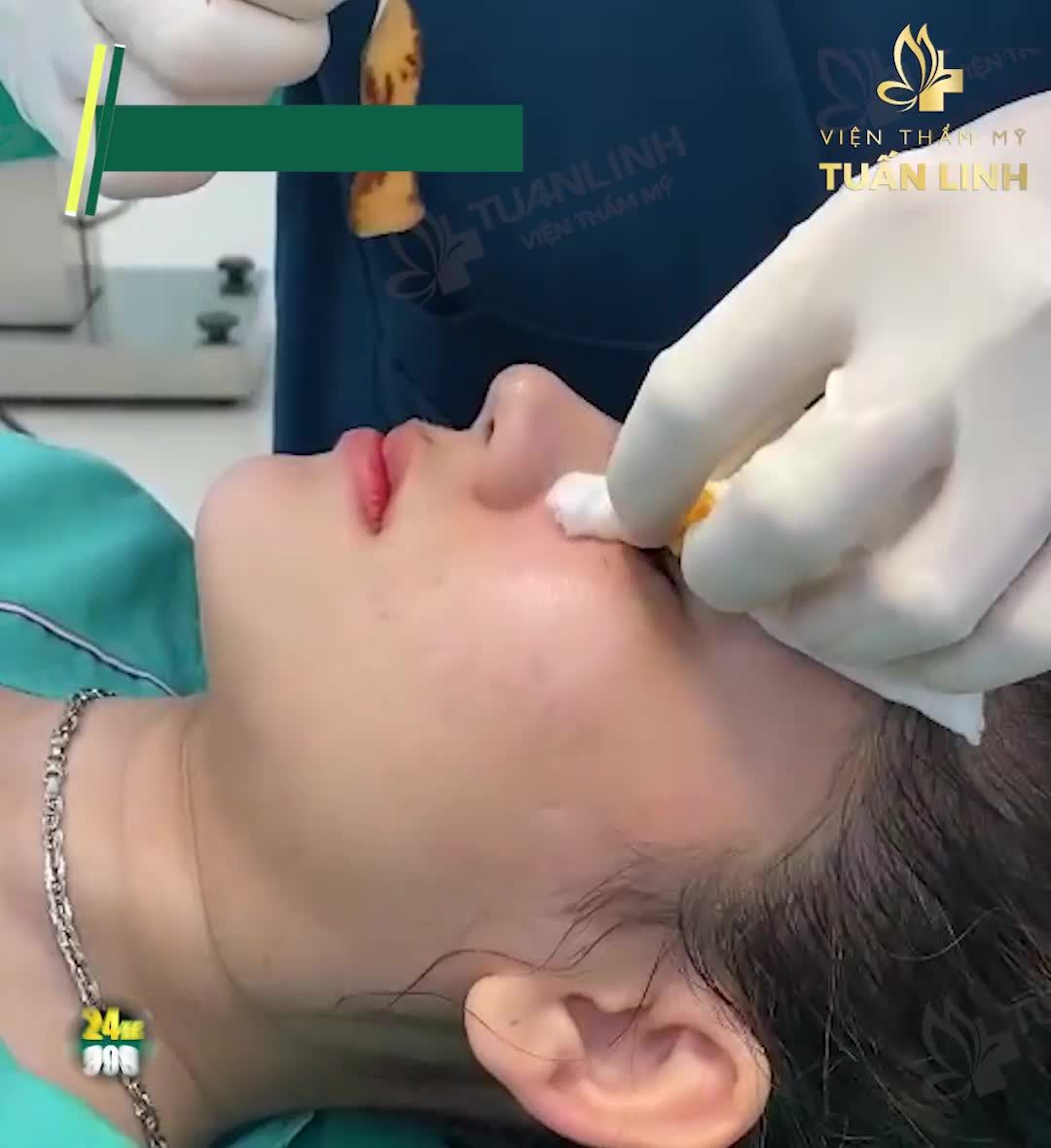 SĂN SALE 9.9 - NÂNG MŨI BÁN CẤU TRÚC CHỈ VỚI 24TR999