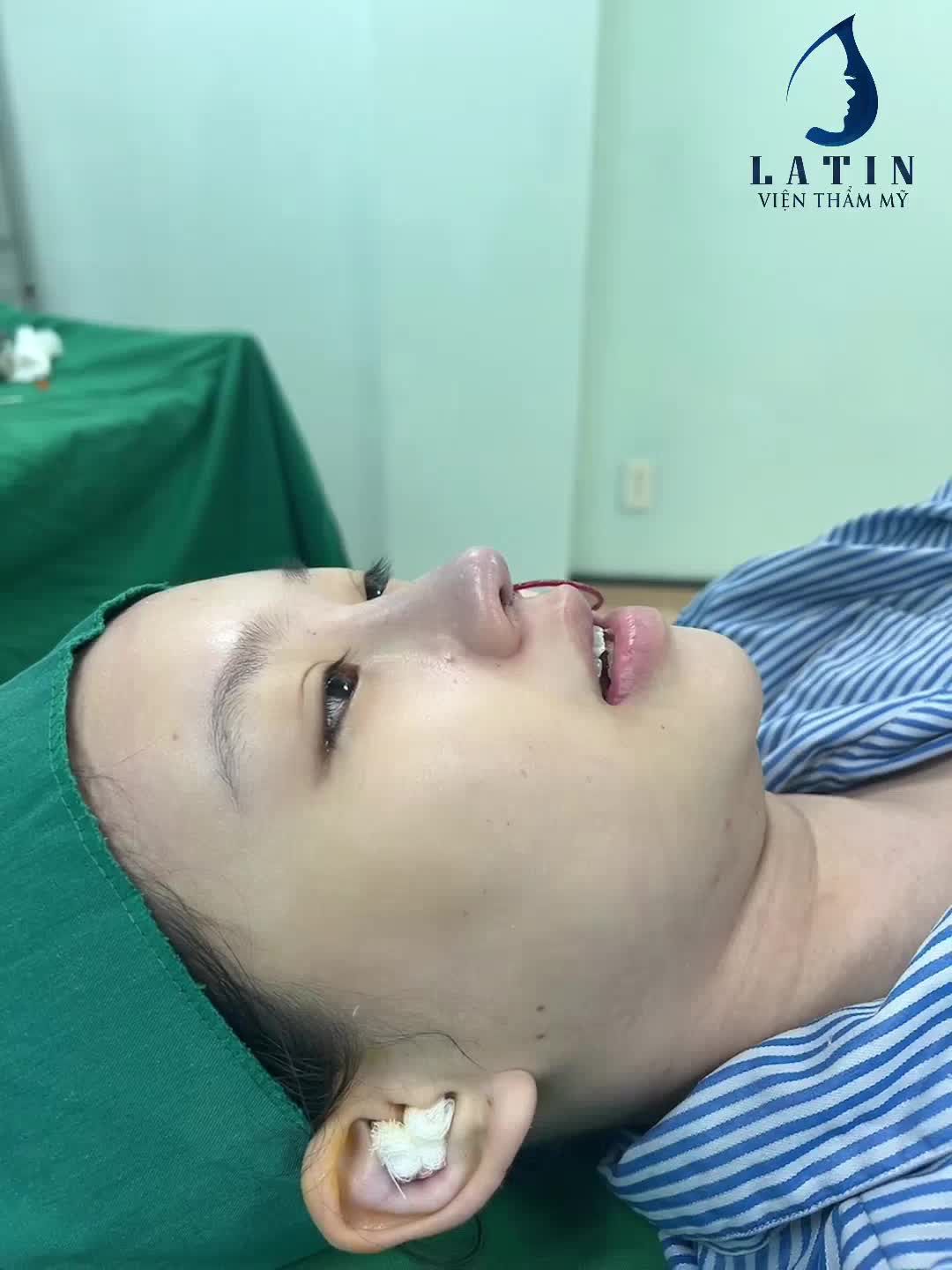 Lấy chỉ mũi và nâng mũi cấu trúc sửa lại thành công cho bạn khách tuổi teen