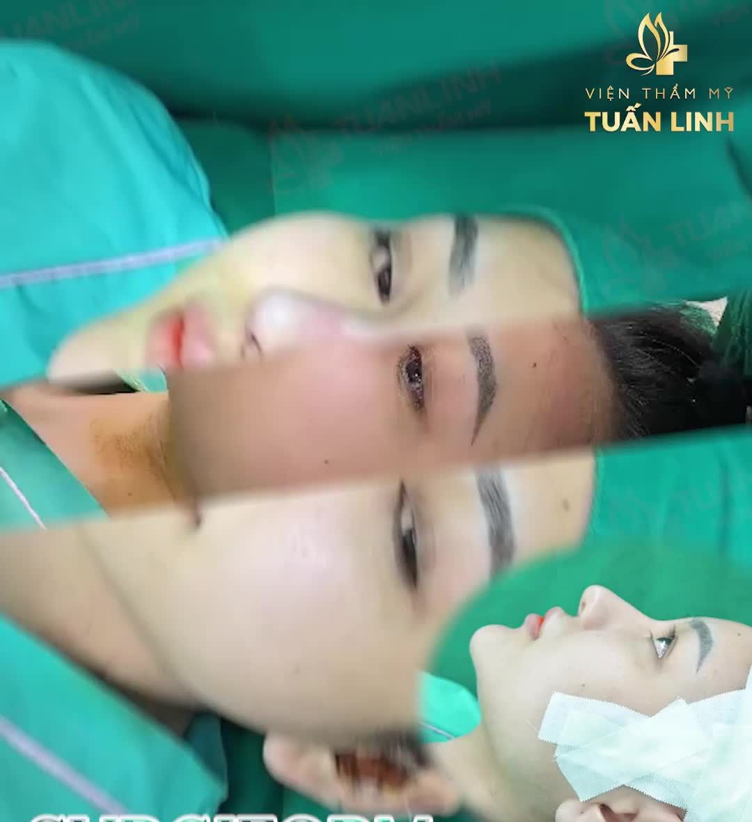 Giải cứu đầu mũi nhọn, cánh mũi hếch, mũi lộ sống, tuột sụn ...Lên dáng mũi đẹp sau 90 phút