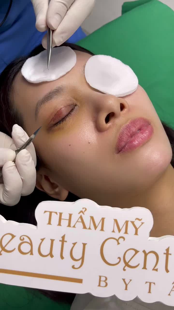 Khách hàng đến thăm khám lại đôi mắt sau 6 ngày thực hiện cắt mí Line Mini tại TMV Tấm.