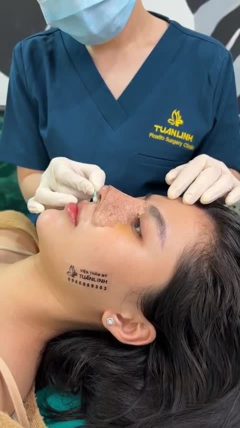 Mũi 5 ngày thay nẹp đẹp xuất sắc luôn ạ