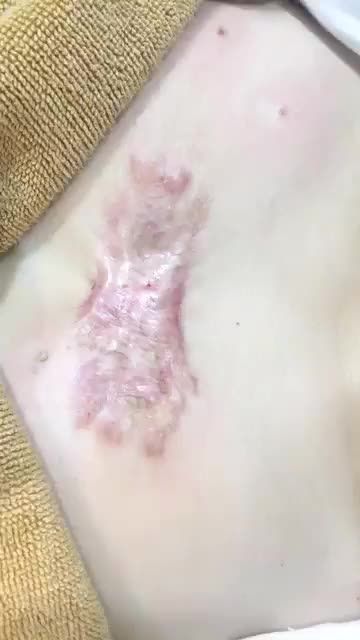 SẸO LỒI KHỦNG điều trị ra sao