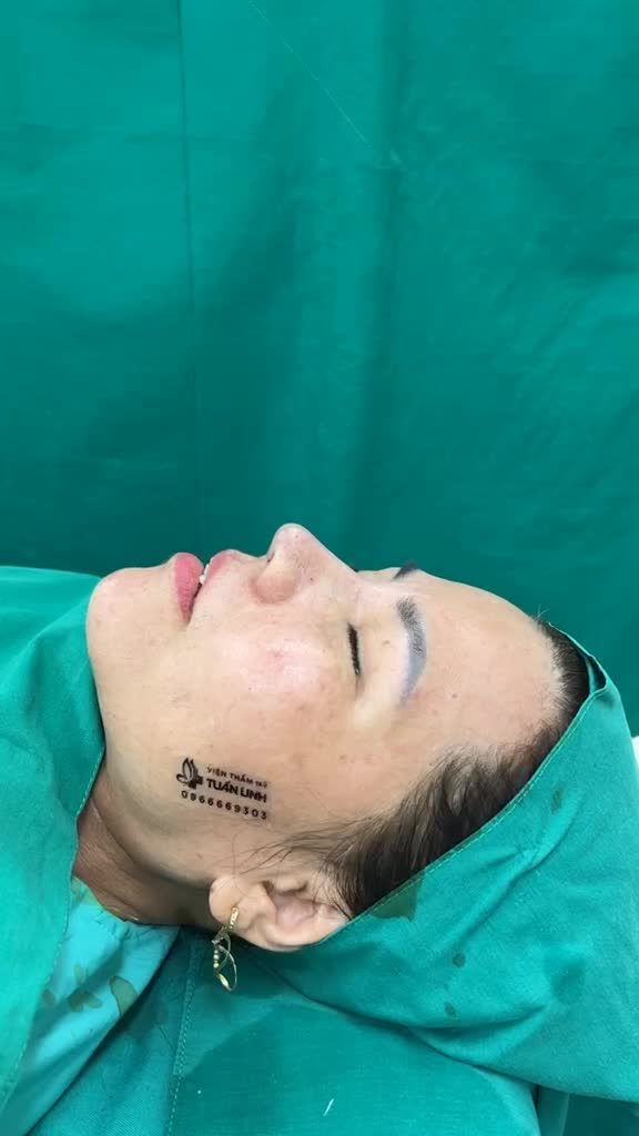 Case nâng mũi cấu trúc sửa lại cho khách hàng đến từ Đà Nẵng