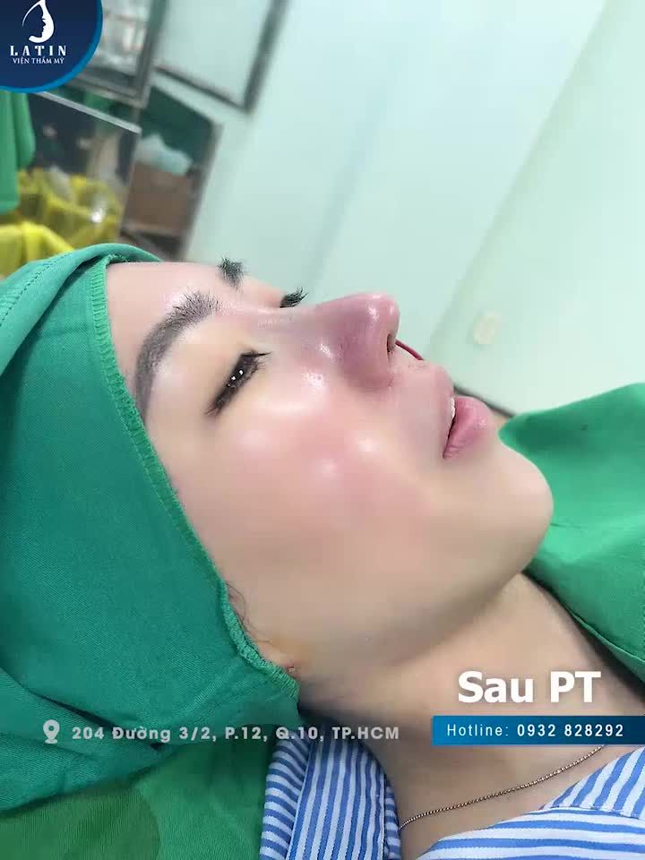 Nâng mũi cấu trúc cho khách hàng từ nước ngoài bay về Việt Nam làm đẹp