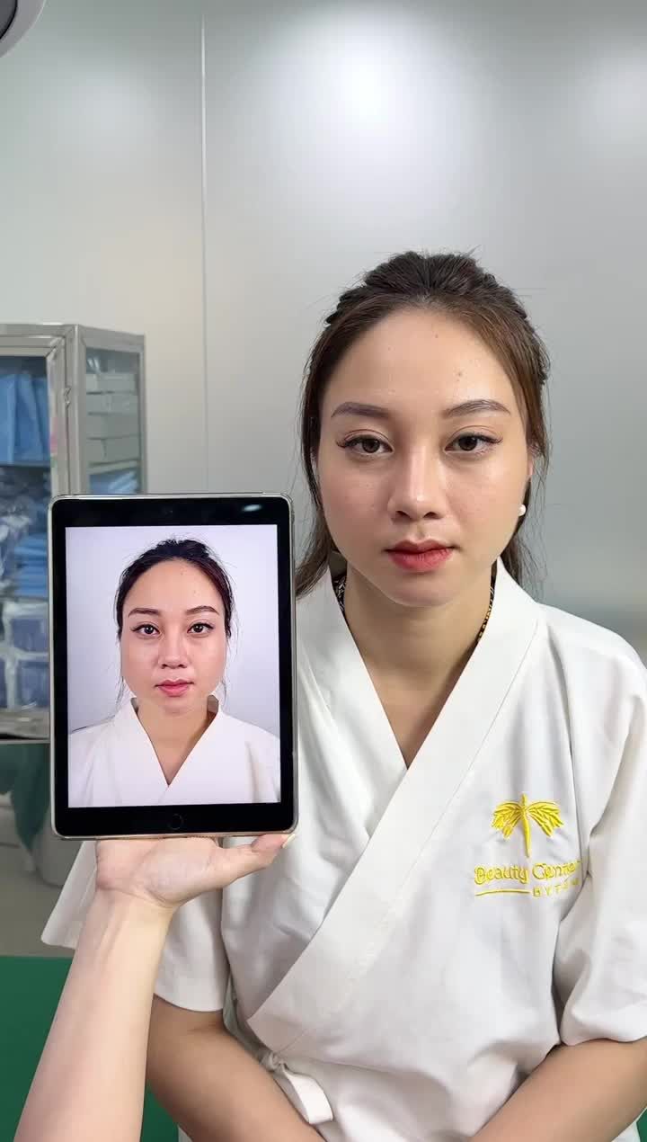 ca làm gọn hàm Vline siêu thành công sau 2 tháng