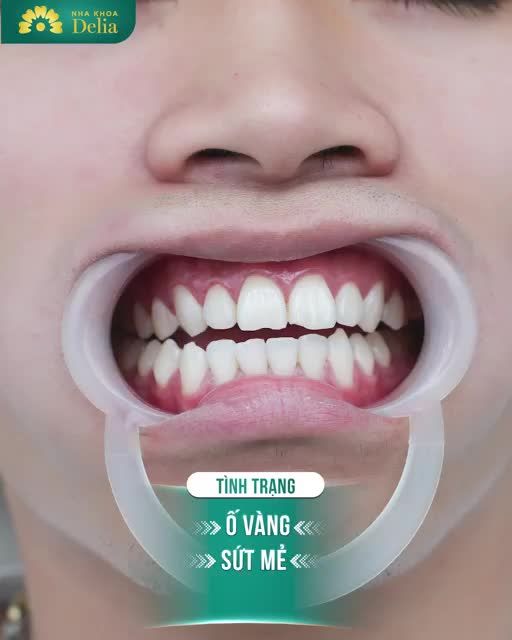 20 răng sứ Ceramill - Món quà to lớn bố mẹ dành tặng con trai!