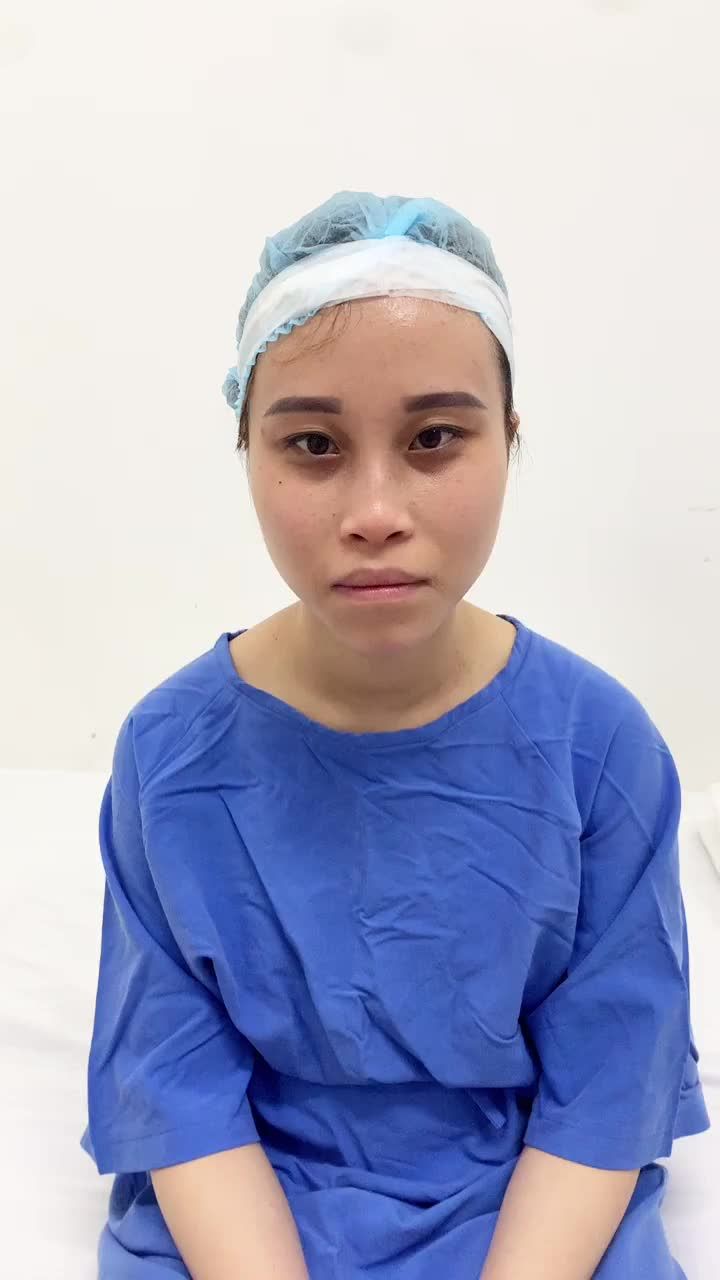 Chỉnh hàm hô công nghệ 3D Face - Design