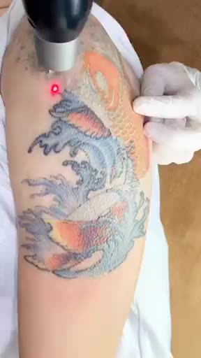 Đã có PICOSURE Chẳng ngại hình xăm nhiều màu