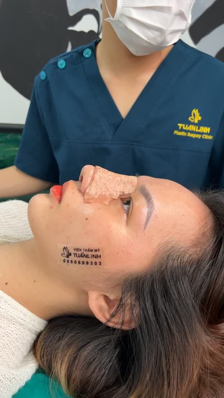 Cô gái đến từ Cần thơ chọn nâng mũi siêu cấu trúc  và kết quả sau 10 ngày tháo nẹp